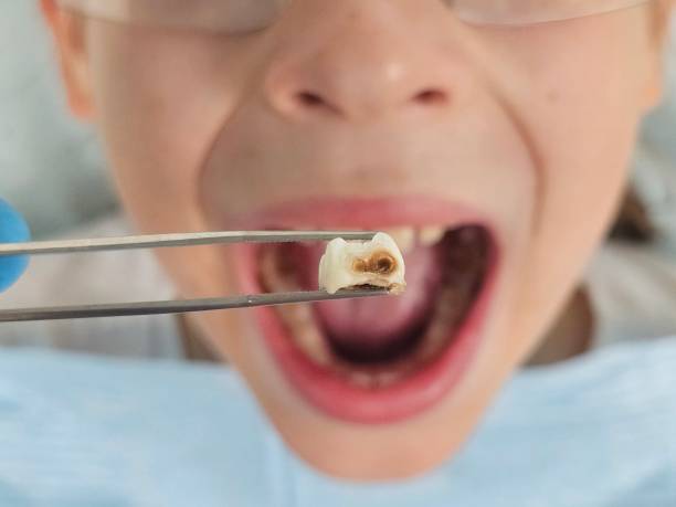 Best Emergency Dentist for Knocked-Out Tooth in East Sonora, CA